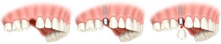 Fogászati implantátum Fogászati implantátum